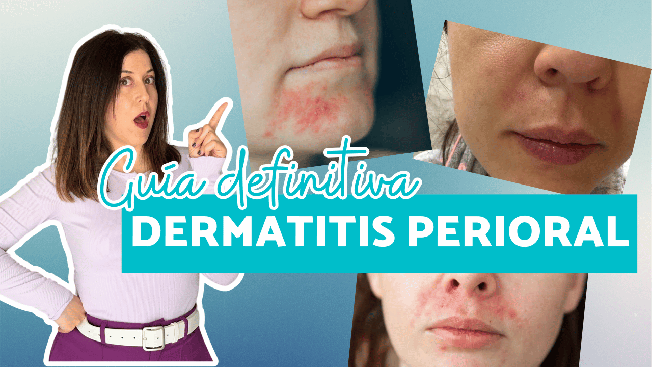 Dermatitis perioral: cómo reconocerla y tratarla correctamente (no es acné)