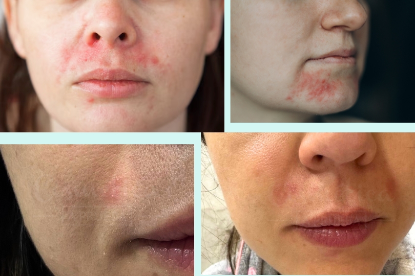 principales causas dermatitis perioral